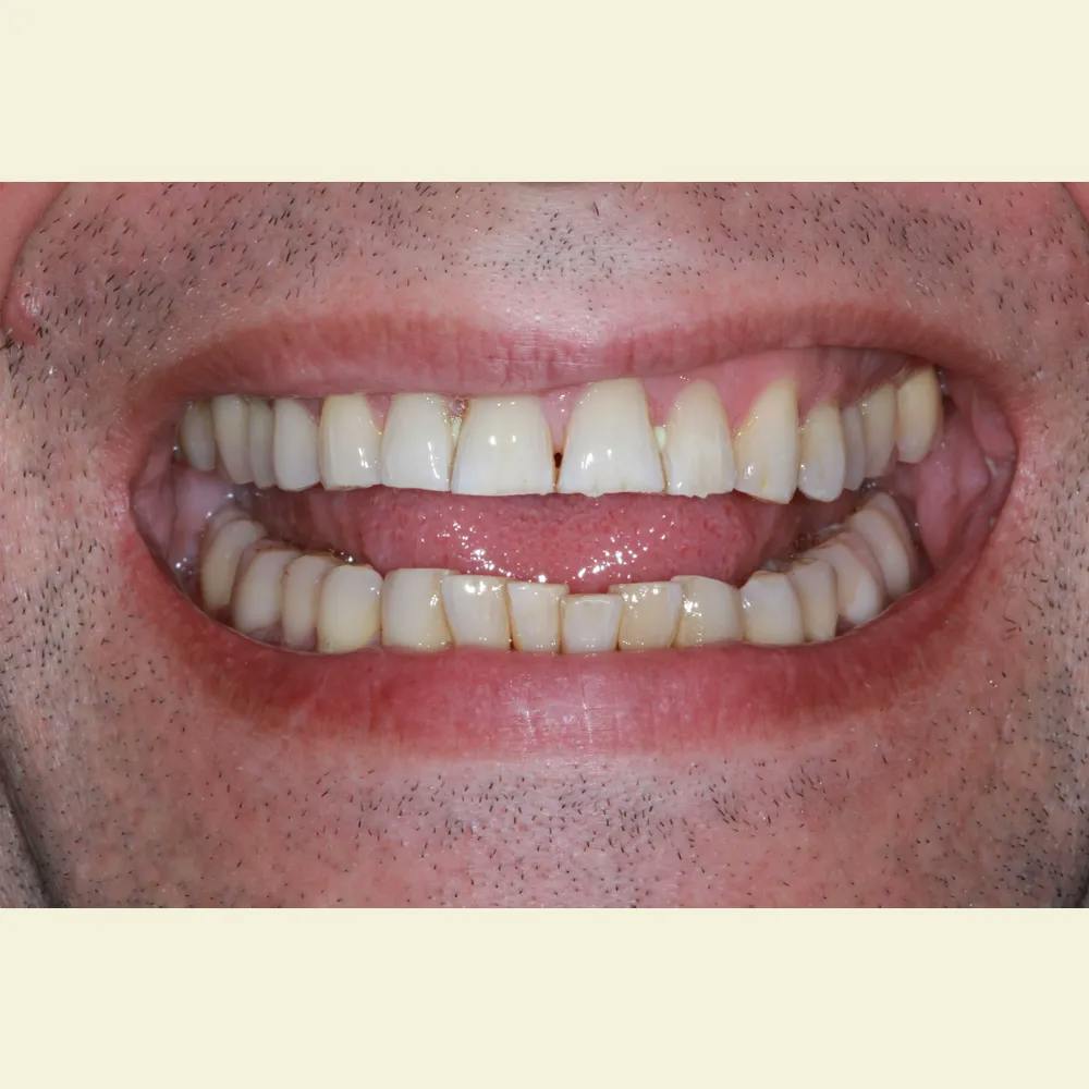 Patient thirteen before