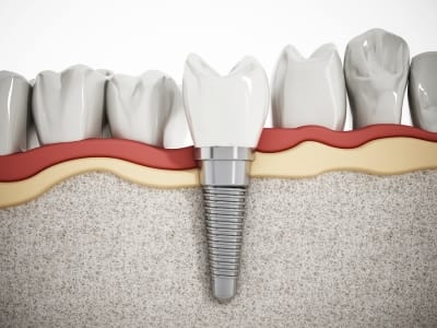 implant crowns