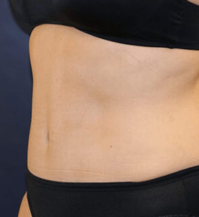 After body contouring