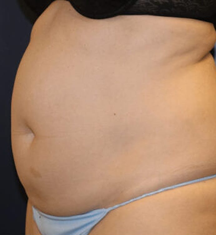 Before body contouring