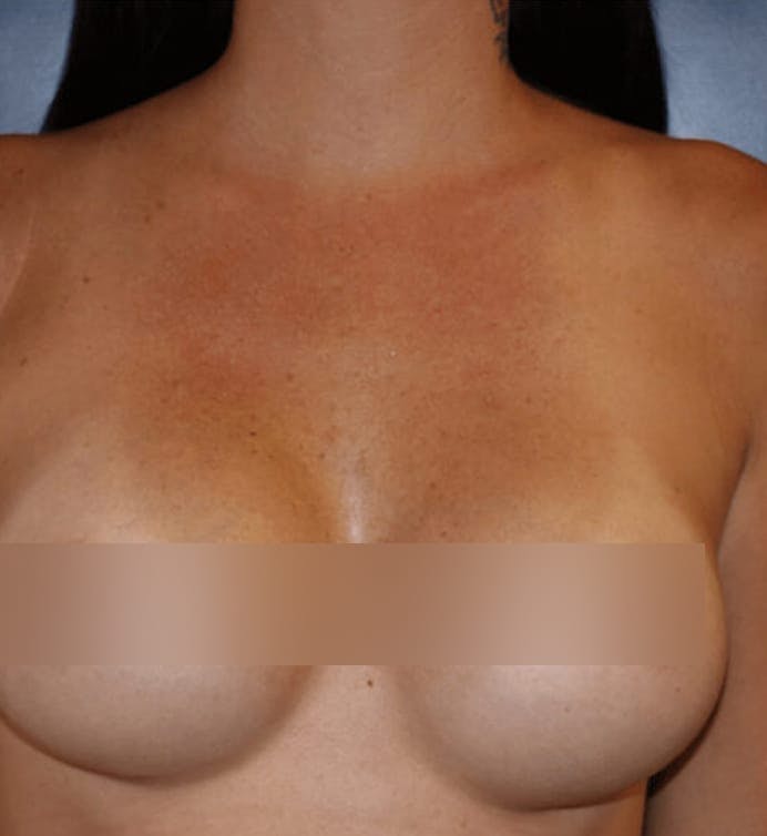 After body contouring