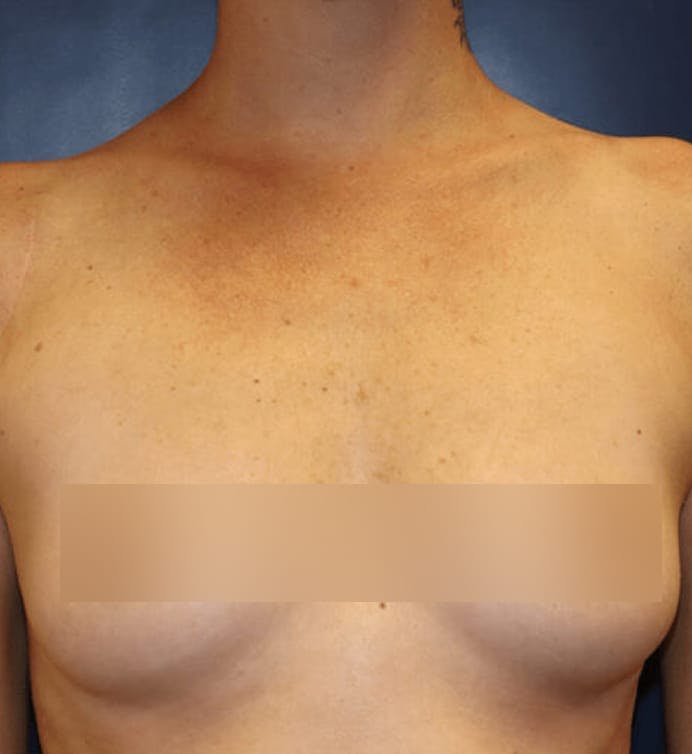 Before body contouring