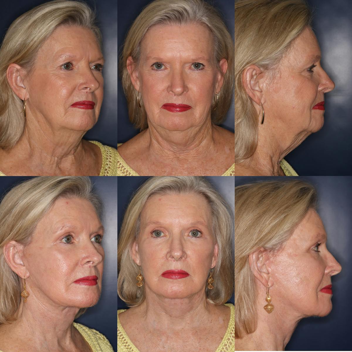 Facelift / Neck Lift Before & After Gallery - Patient 311002 - Image 1