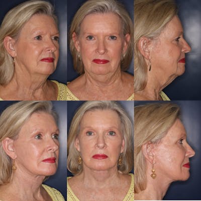 Facelift / Neck Lift Before & After Gallery - Patient 311002 - Image 1