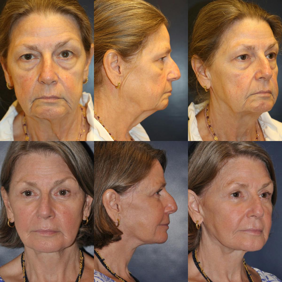 Facelift / Neck Lift Before & After Gallery - Patient 277833 - Image 1