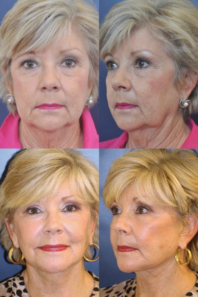 Facelift / Neck Lift Before & After Gallery - Patient 427474 - Image 1