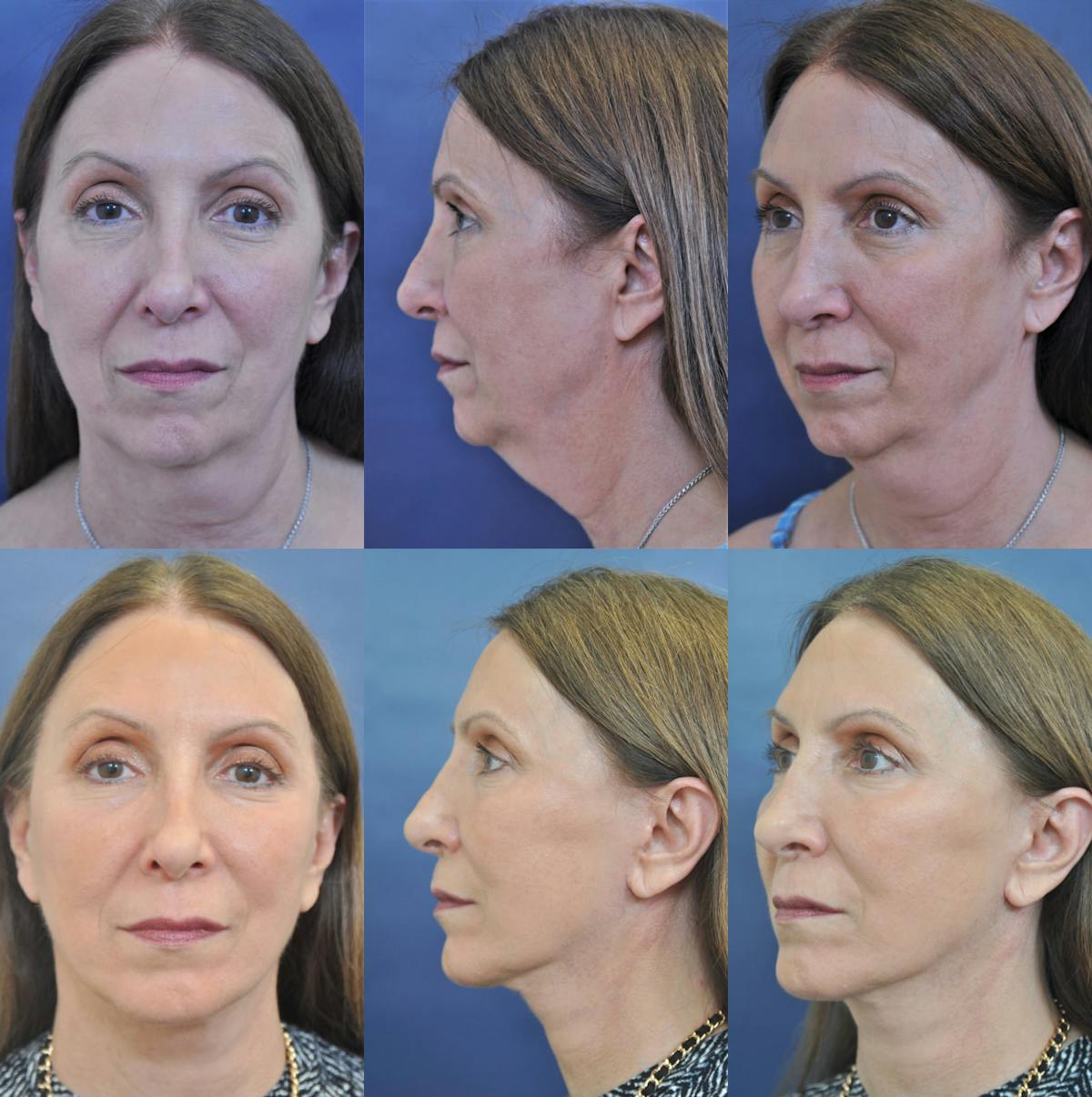Facelift / Neck Lift Before & After Gallery - Patient 381396 - Image 1