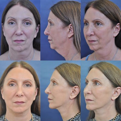 Facelift / Neck Lift Before & After Gallery - Patient 381396 - Image 1