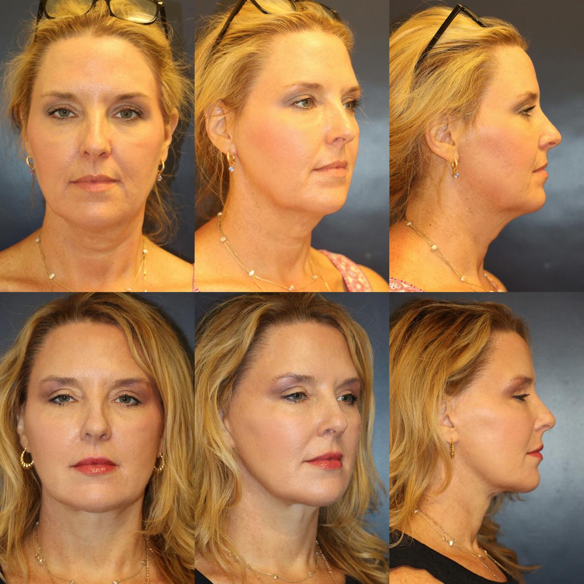 Facelift / Neck Lift Before & After Gallery - Patient 525470 - Image 1