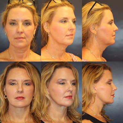 Facelift / Neck Lift Before & After Gallery - Patient 525470 - Image 1