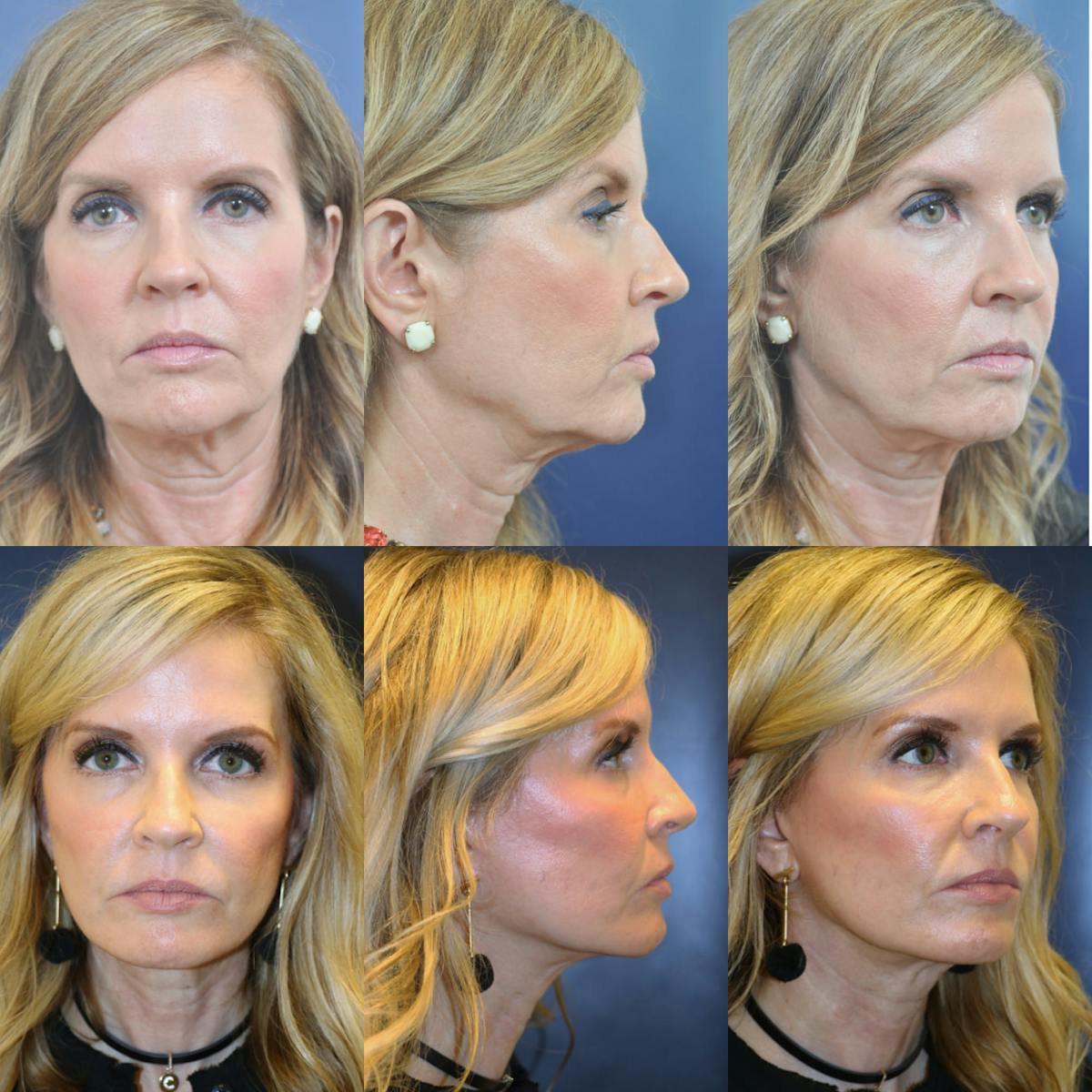 Facelift / Neck Lift Before & After Gallery - Patient 632059 - Image 1