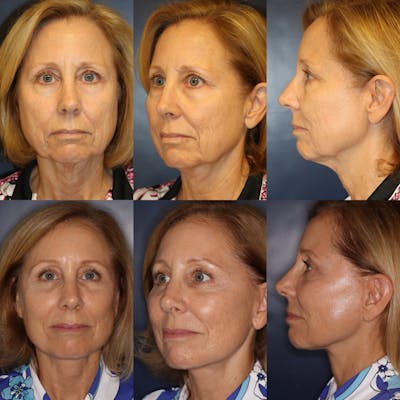 Facelift / Neck Lift Before & After Gallery - Patient 334219 - Image 1