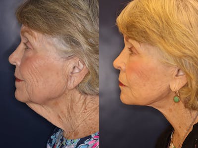 Facelift / Neck Lift Before & After Gallery - Patient 232960 - Image 1