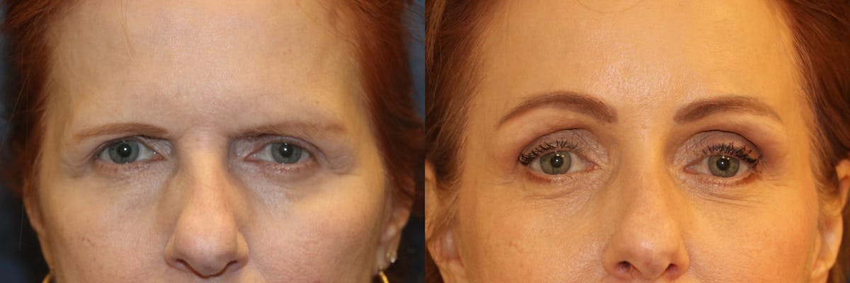 Brow lift Before & After Gallery - Patient 424253 - Image 1