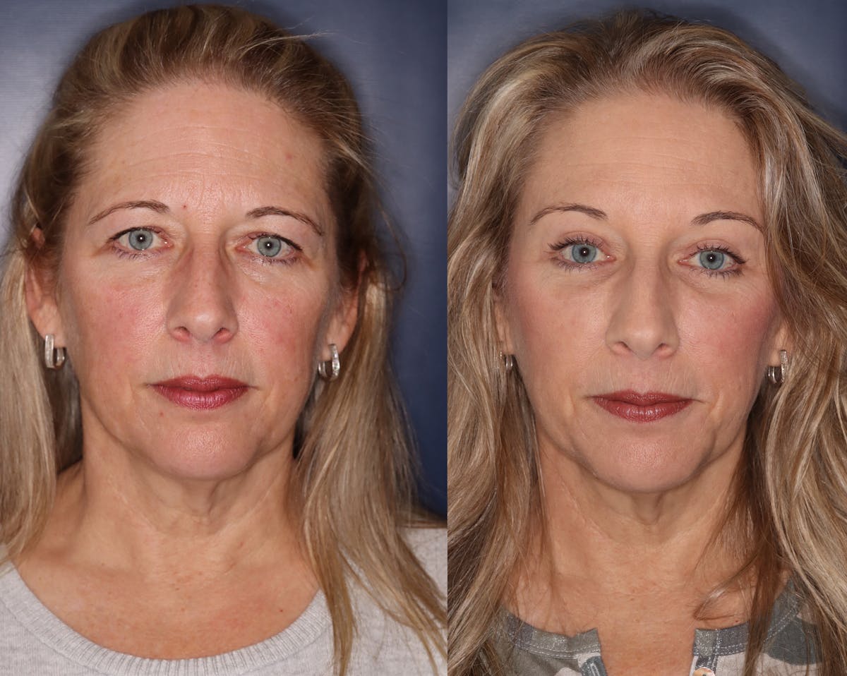 Brow lift Before & After Gallery - Patient 221255 - Image 1