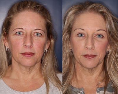 Brow lift Before & After Gallery - Patient 221255 - Image 1