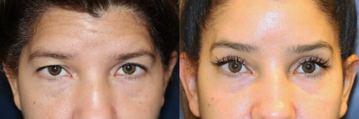 Brow lift Before & After Gallery - Patient 266297 - Image 1