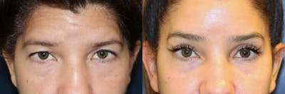 Brow lift Before & After Gallery - Patient 266297 - Image 1