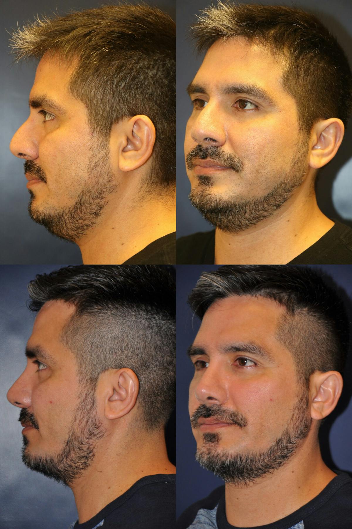 Rhinoplasty Before & After Gallery - Patient 330380 - Image 1