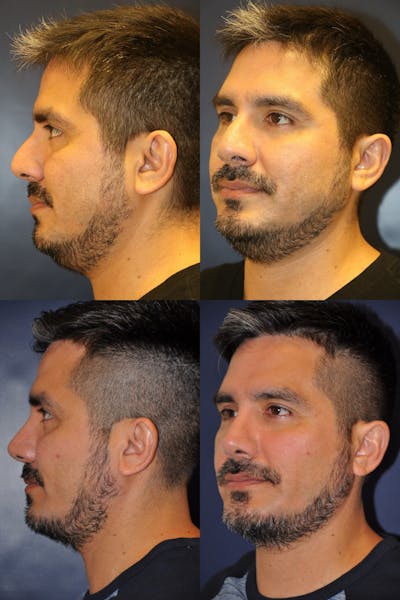 Rhinoplasty Before & After Gallery - Patient 330380 - Image 1