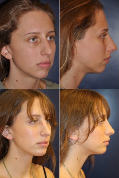 Rhinoplasty Before & After Gallery - Patient 237039 - Image 1