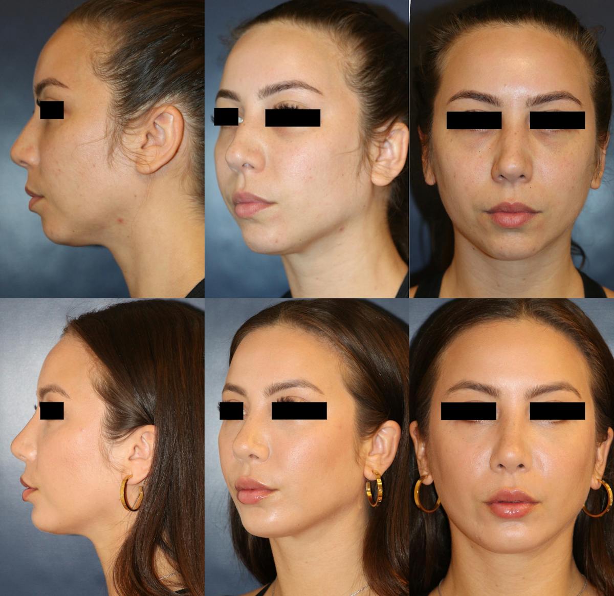 Rhinoplasty Before & After Gallery - Patient 341136 - Image 1
