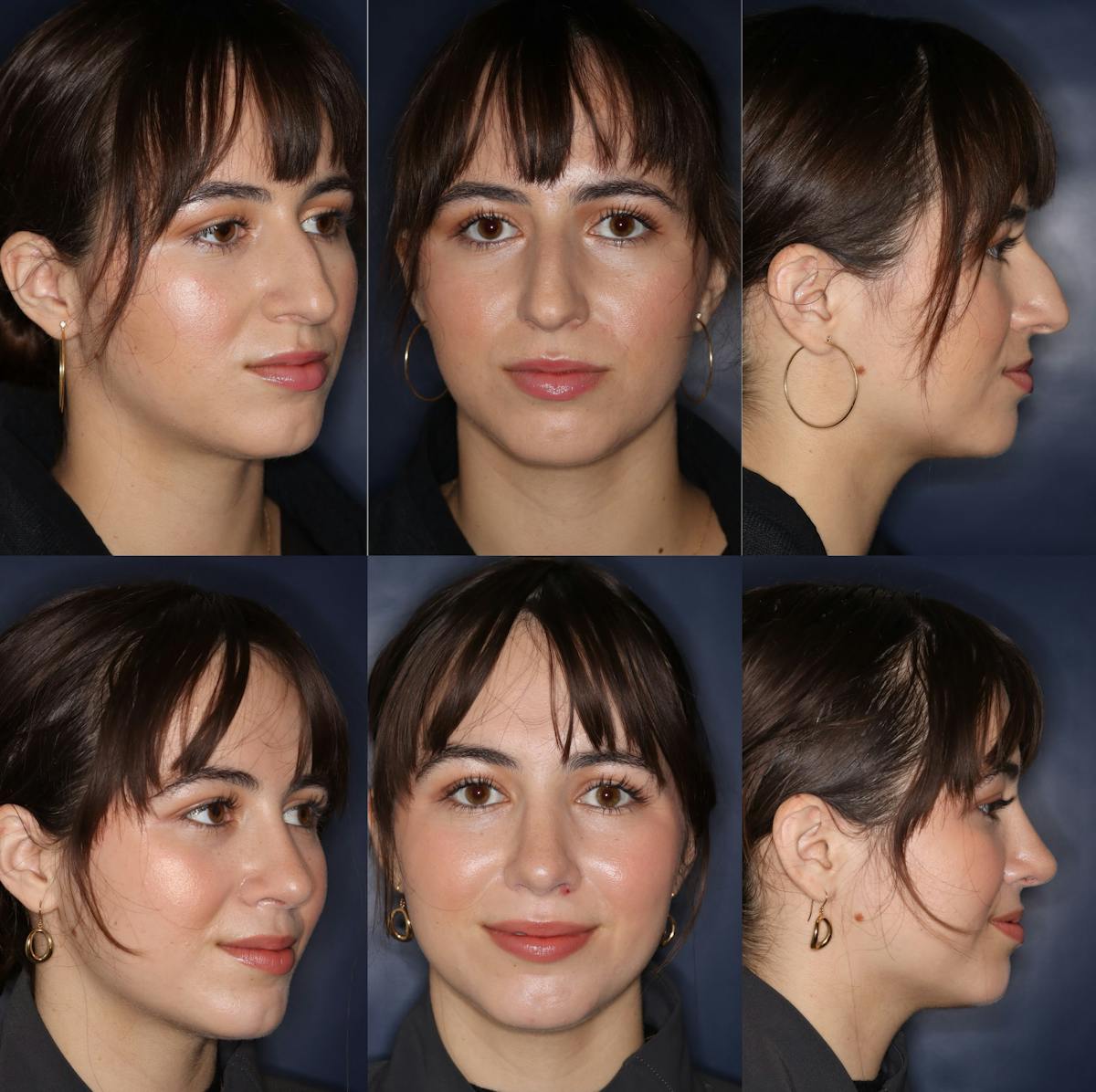 Rhinoplasty Before & After Gallery - Patient 119216 - Image 1