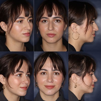 Rhinoplasty Before & After Gallery - Patient 119216 - Image 1