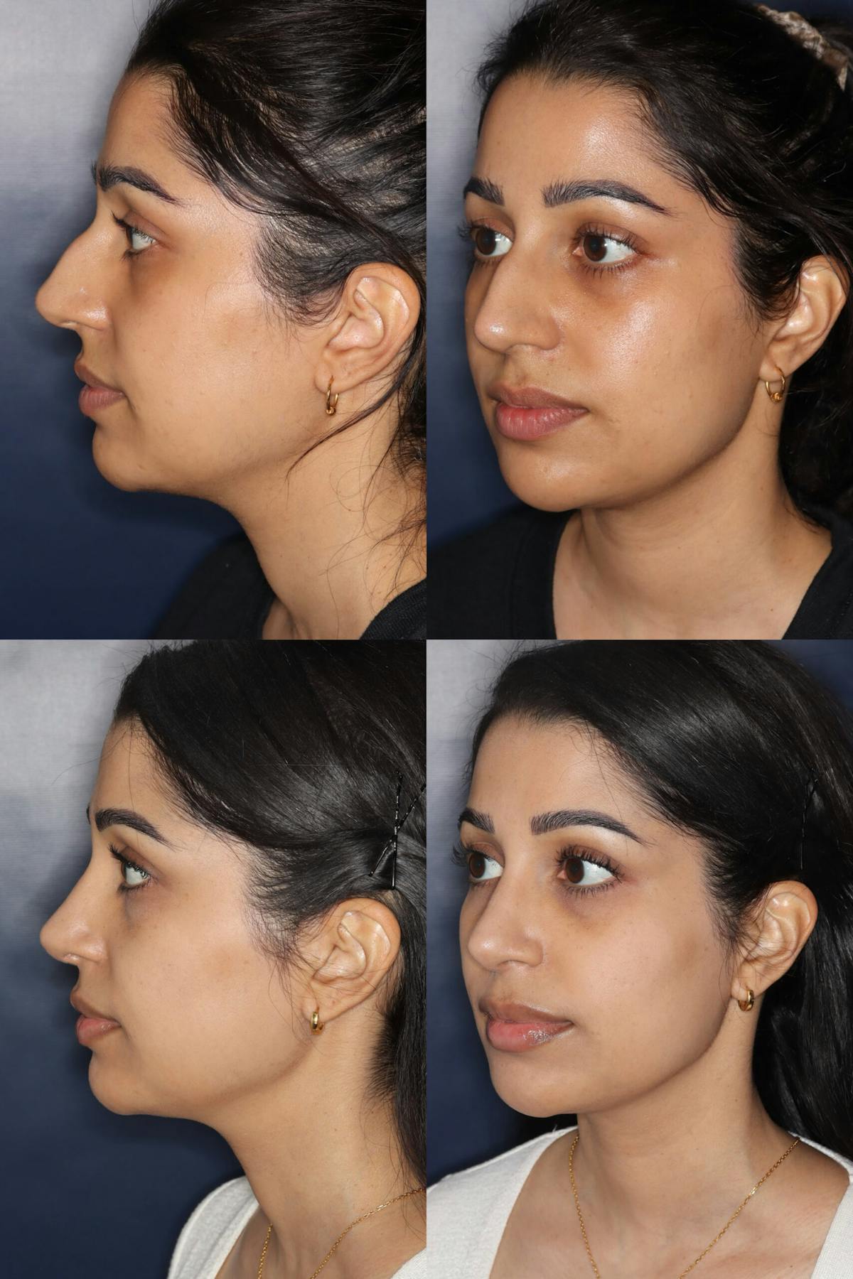 Rhinoplasty Before & After Gallery - Patient 879323 - Image 1