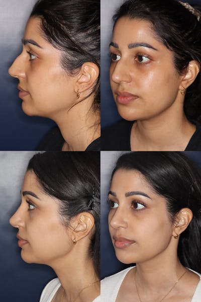 Rhinoplasty Before & After Gallery - Patient 879323 - Image 1