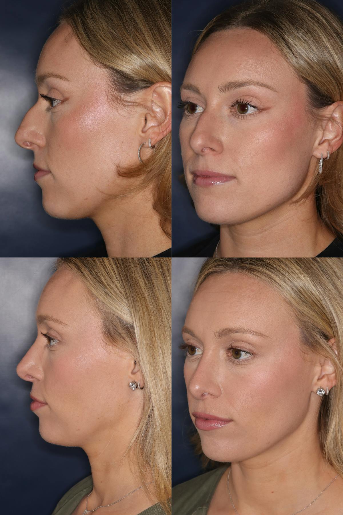 Rhinoplasty Before & After Gallery - Patient 364880 - Image 1