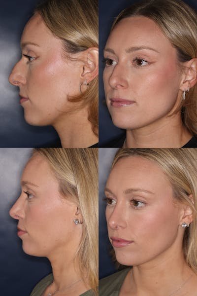 Rhinoplasty Before & After Gallery - Patient 364880 - Image 1