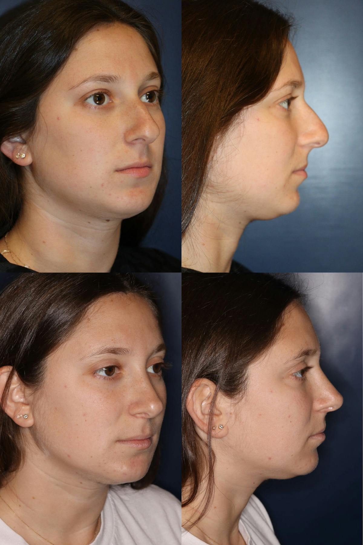 Rhinoplasty Before & After Gallery - Patient 407401 - Image 1