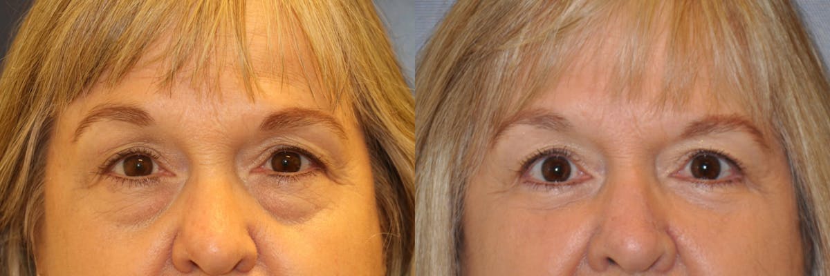 Blepharoplasty Before & After Gallery - Patient 287530 - Image 1