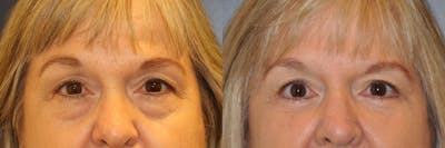 Blepharoplasty Before & After Gallery - Patient 287530 - Image 1