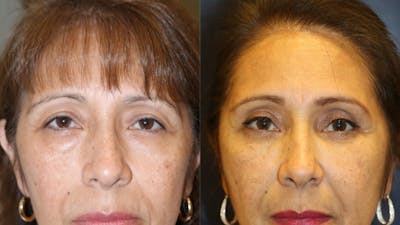 Blepharoplasty Before & After Gallery - Patient 148686 - Image 1