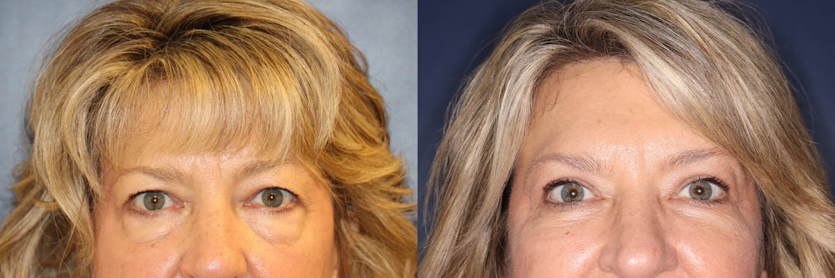 Blepharoplasty Before & After Gallery - Patient 199416 - Image 1