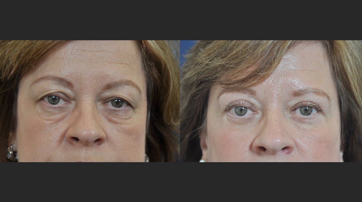 Blepharoplasty Before & After Gallery - Patient 254591 - Image 1