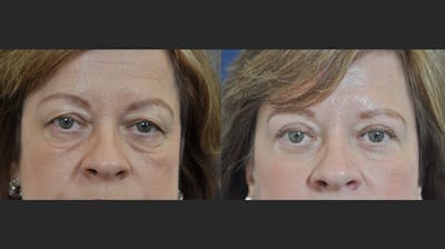 Blepharoplasty Before & After Gallery - Patient 254591 - Image 1