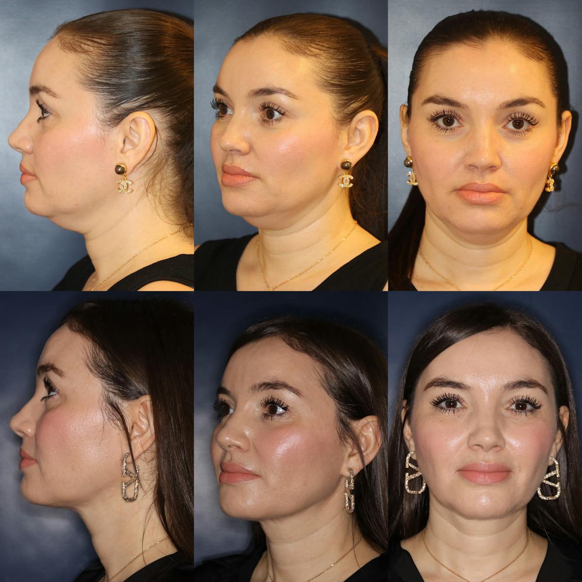 Facetite Before & After Gallery - Patient 158886 - Image 1