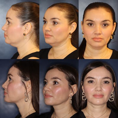 Facetite Before & After Gallery - Patient 158886 - Image 1