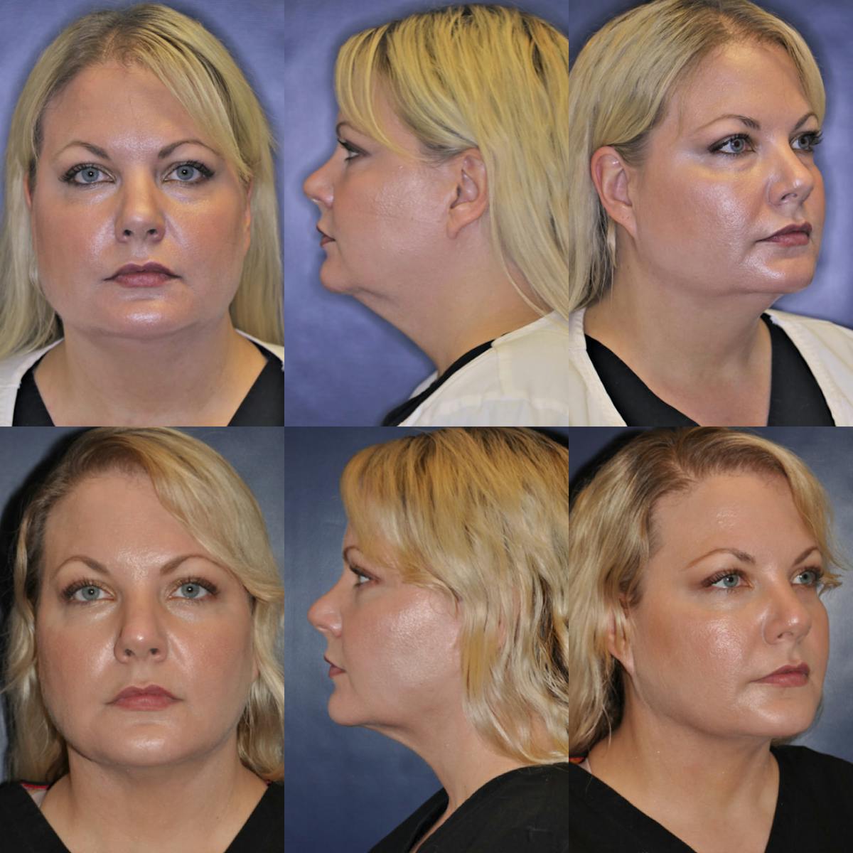 Facetite Before & After Gallery - Patient 344599 - Image 1