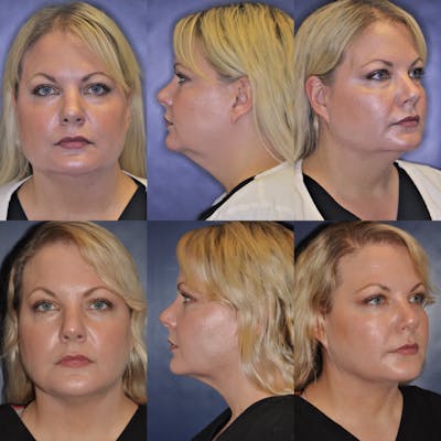 Facetite Before & After Gallery - Patient 344599 - Image 1