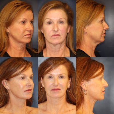 Facetite Before & After Gallery - Patient 122396 - Image 1
