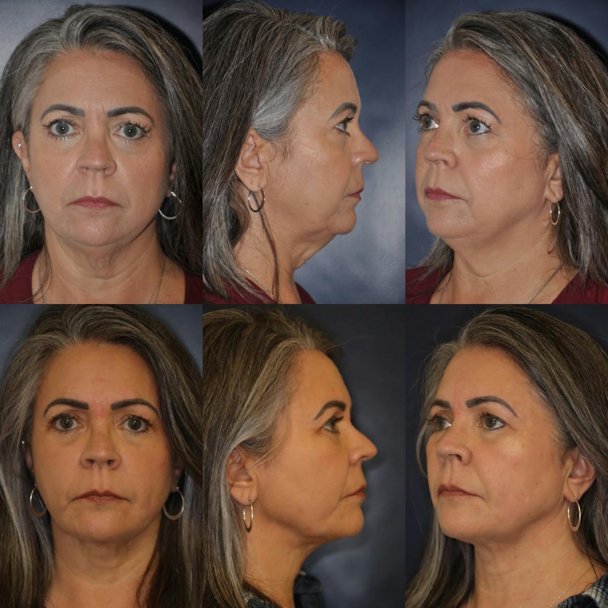 Facetite Before & After Gallery - Patient 196882 - Image 1