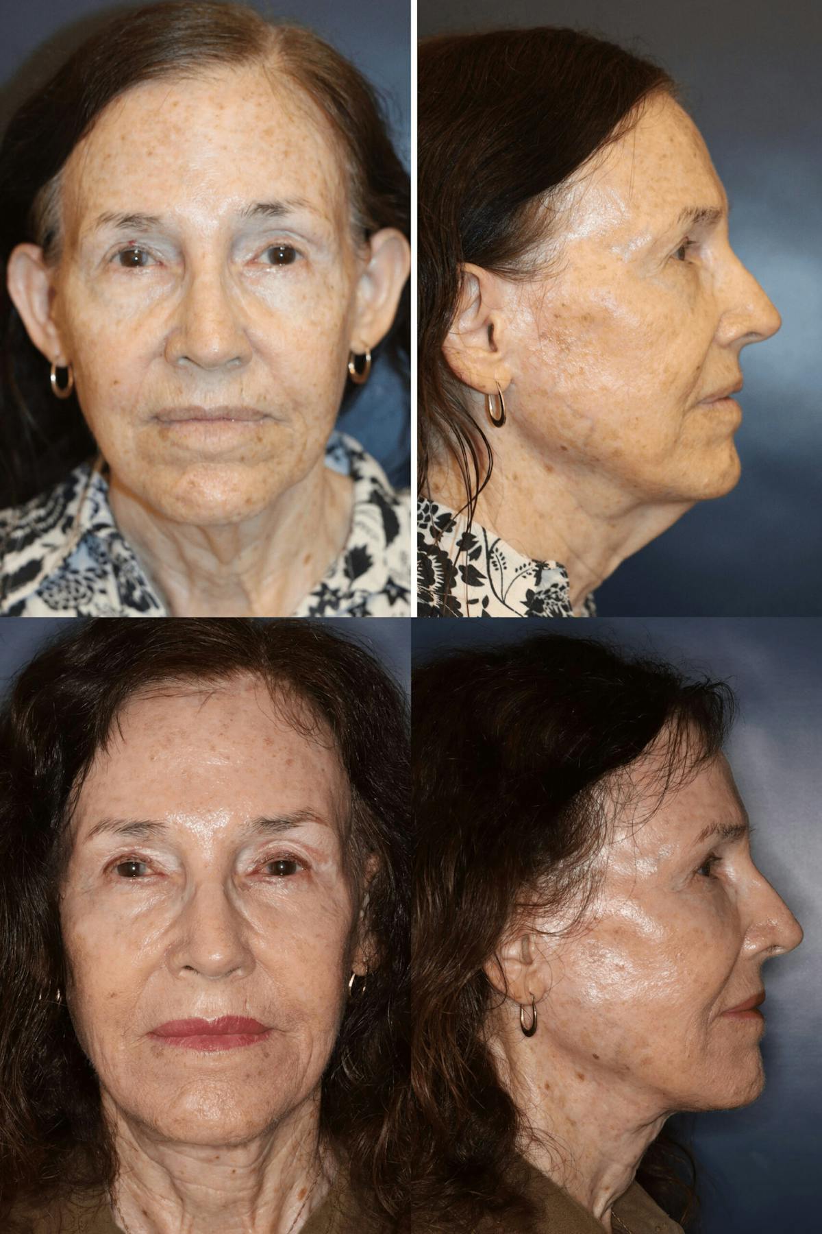 Facetite Before & After Gallery - Patient 156063 - Image 1