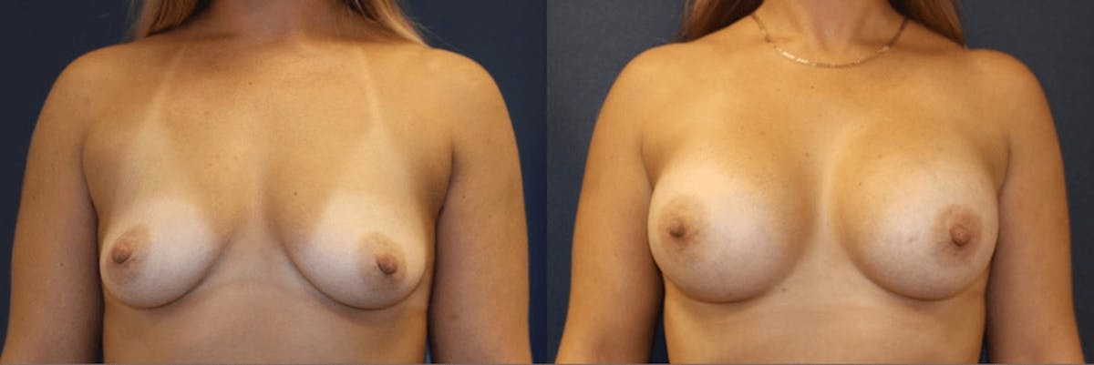 Breast Augmentation Before & After Gallery - Patient 282356 - Image 1