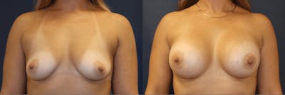 Breast Augmentation Before & After Gallery - Patient 282356 - Image 1