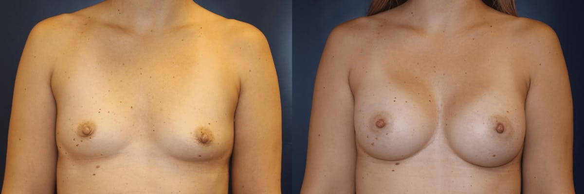 Breast Augmentation Before & After Gallery - Patient 350807 - Image 1
