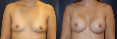 Breast Augmentation Before & After Gallery - Patient 350807 - Image 1